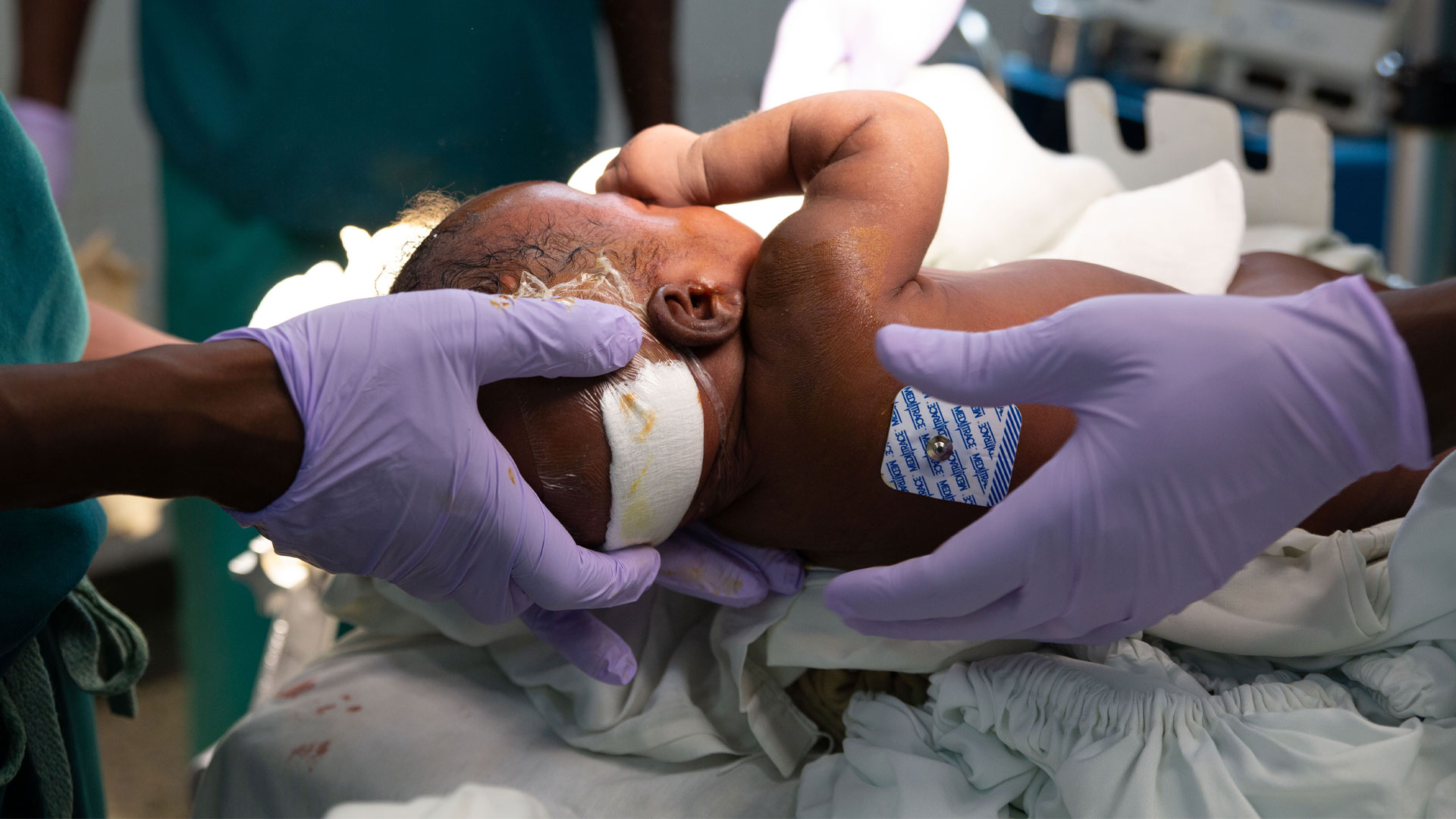Encephalocele in Uganda: ethnic distinctions in lesion location, endoscopic management of hydrocephalus, and survival in 110 consecutive children