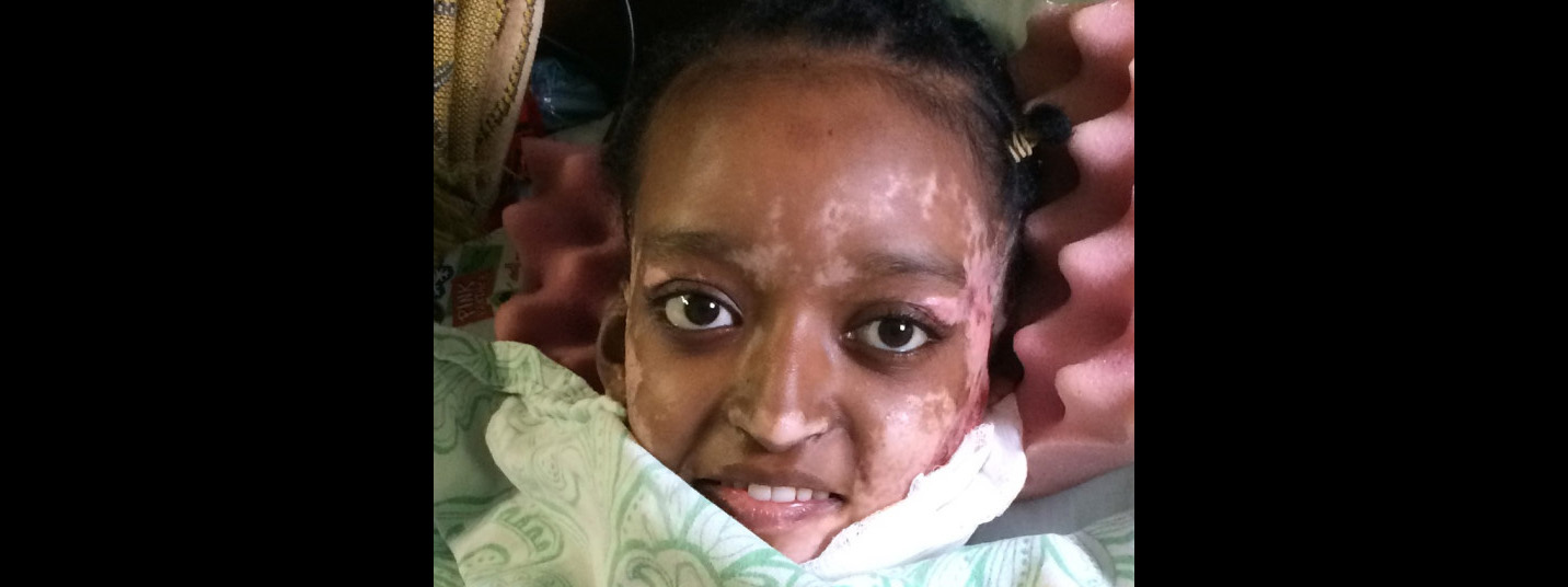Burn Patient Halima Reconnects with God After Accident