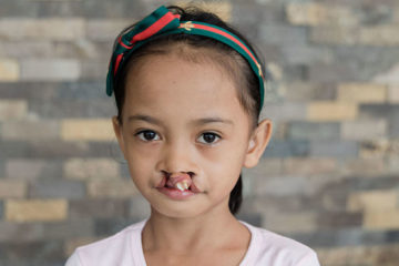 AnnaRose shows the large holes in her upper lip that prevent her from closing her mouth