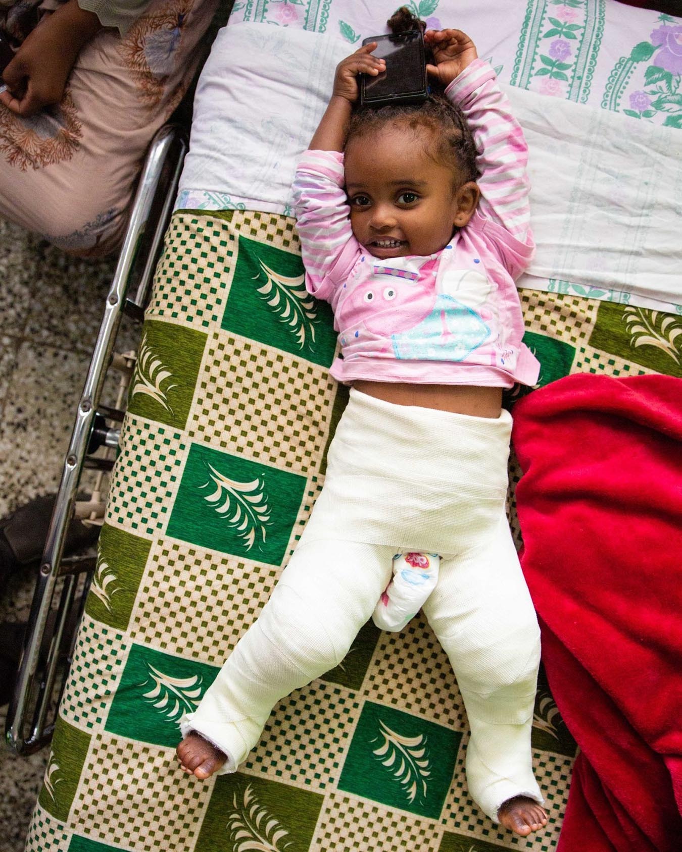 Neglected, Traumatic Hip Dislocation in Children in Ethiopia