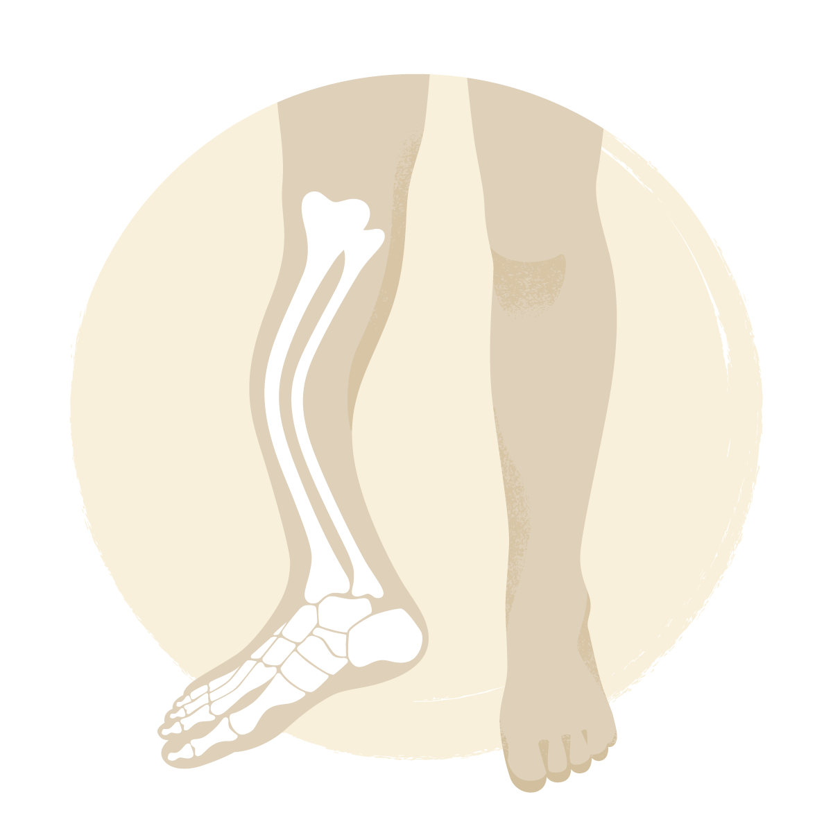 brittle-bone-disorder-costamedic