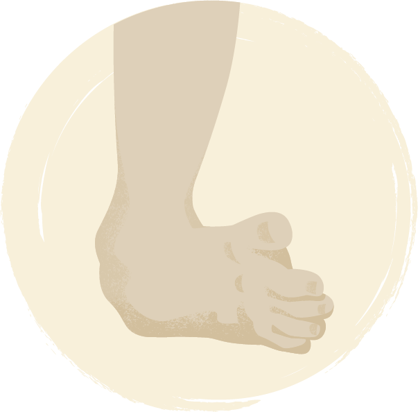 On the cure of club-foot without cutting tendons : and on certain