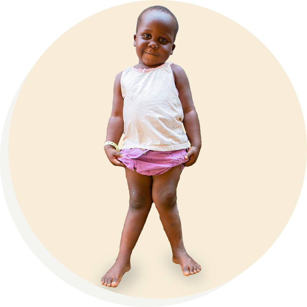 Knock Knees (Genu Valgum) (for Parents) - Nemours KidsHealth