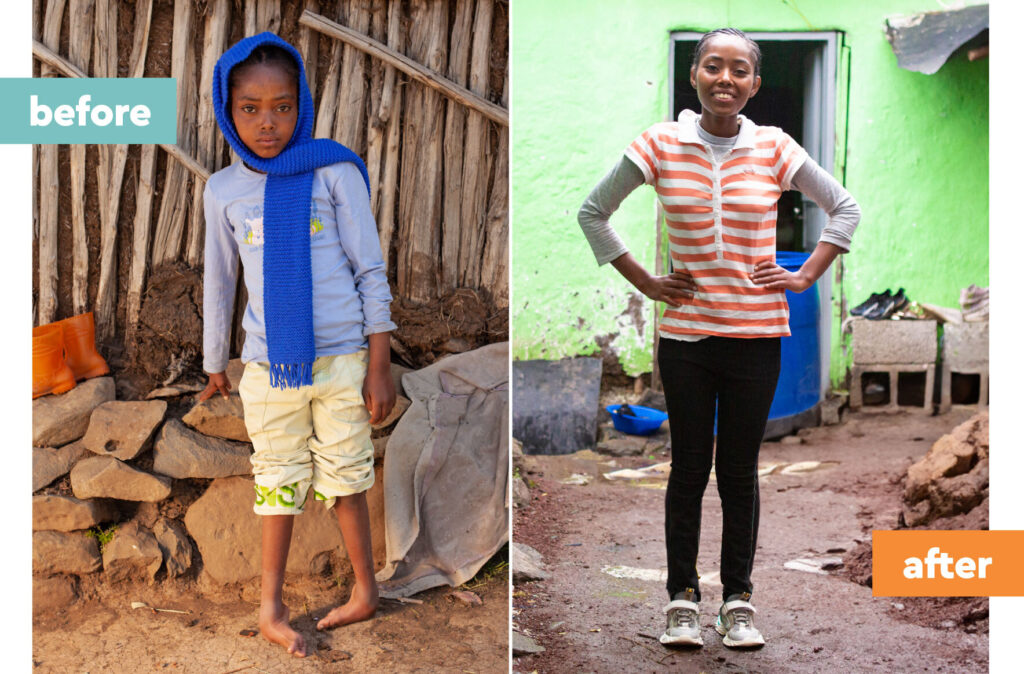 Surgery Straightened Megertu’s Feet and Helped Other Children in Need