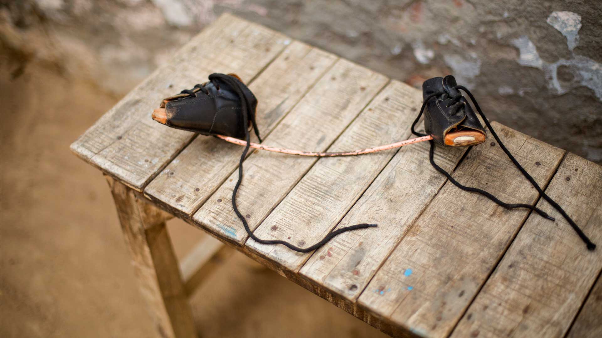 Ponseti clubfoot management Experience with the Steenbeek foot