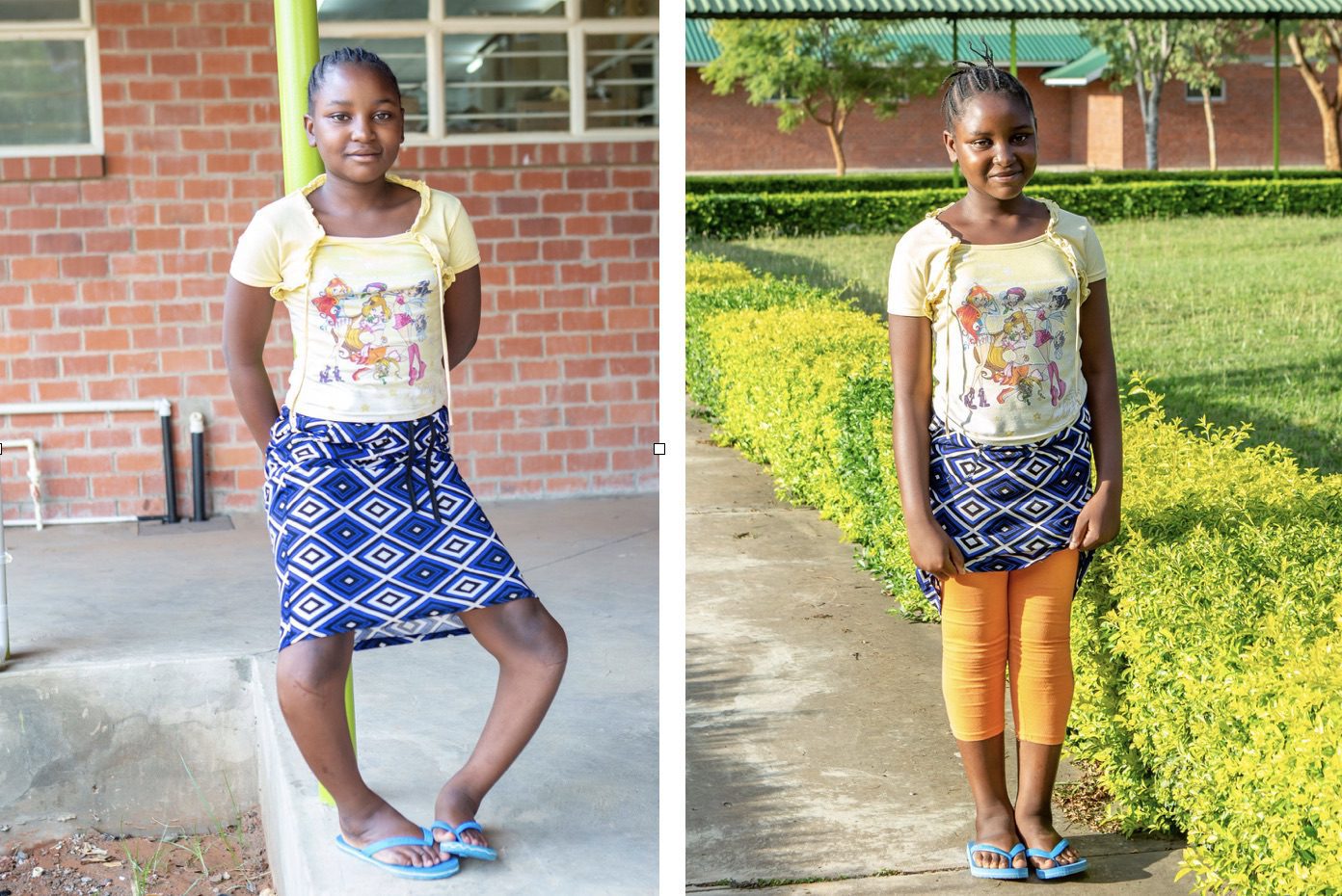 Surgery Straightened Her Legs. Now Nanga is on the Right Path. - CURE