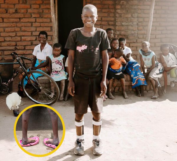 Boy standing smiling with club feet