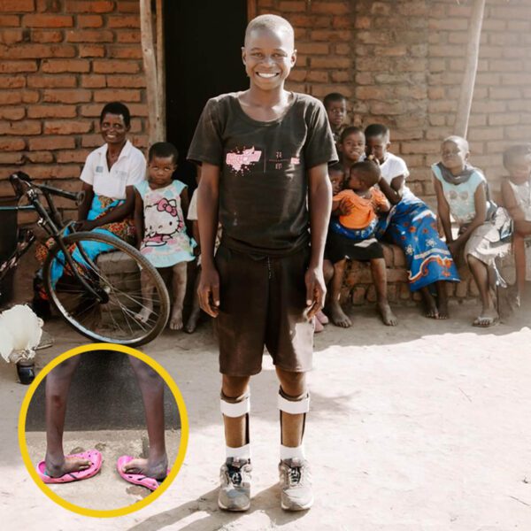 Boy standing smiling with club feet