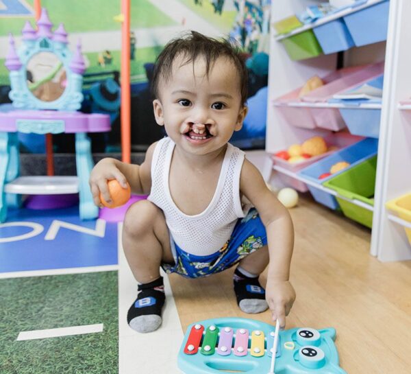 child with clef lip playing with toys