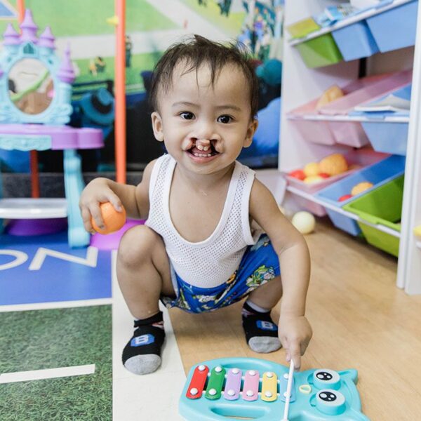 child with clef lip playing with toys