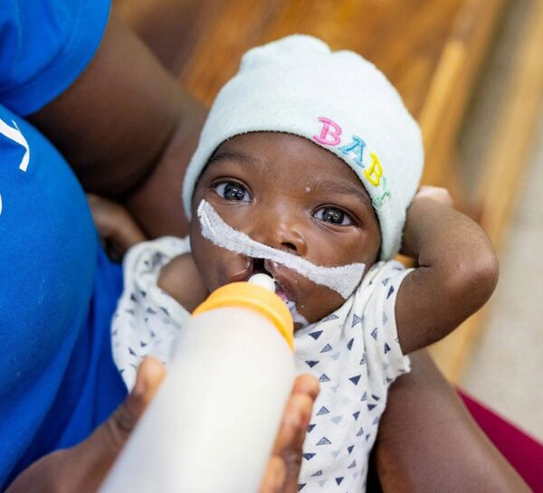 Baby with cleft lip drinking from a bottle