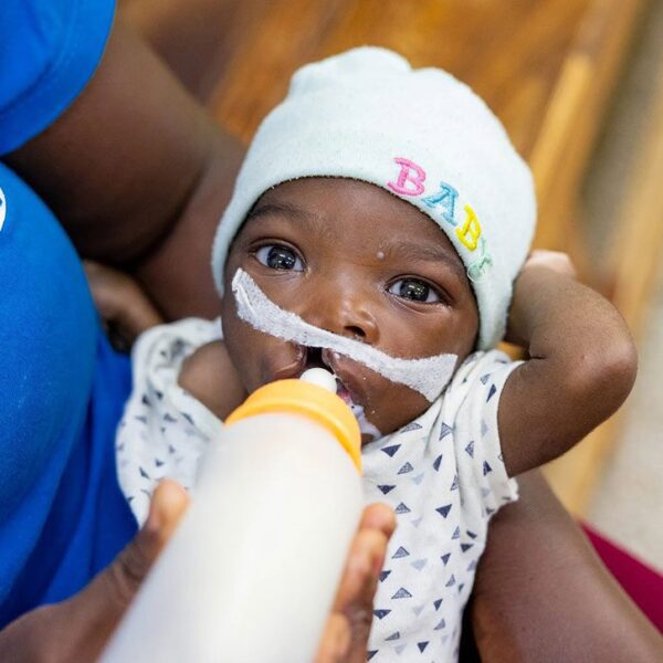 Baby with cleft lip drinking from a bottle