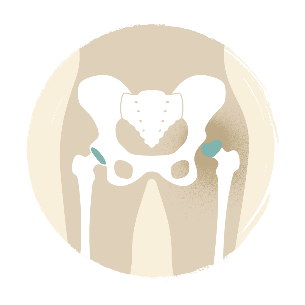Picture of Hip Dysplasia - CURE