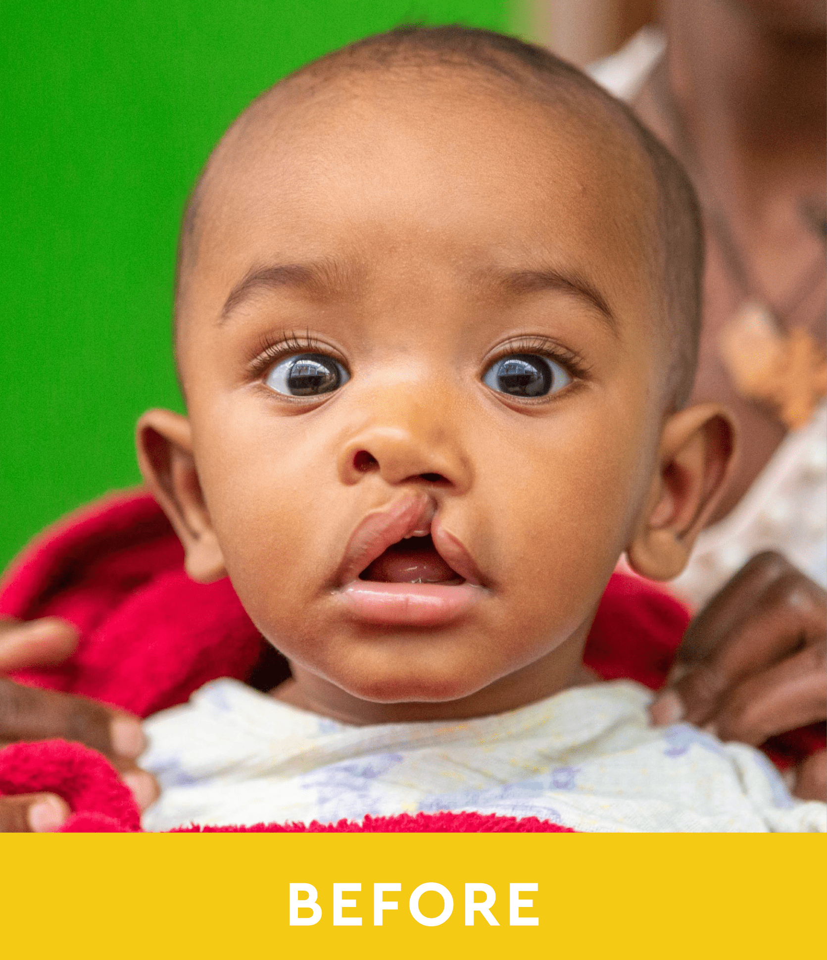 Cleft Lip Repair Changes Everything—Ask Kidus! - CURE