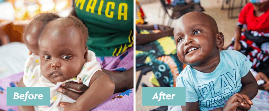 A side-by-side photo showing the dramatic results of treatment for hydrocephalus. The 'Before' photo shows a baby with an enlarged head and a somber expression, being held by an adult. The 'After' photo shows the same child, with a normal head size and a wide, joyful smile, looking up.